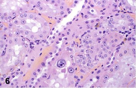 Renal tubule cell karyomegaly